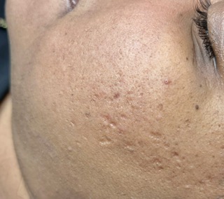 Before Microneedling