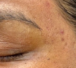 Before Microneedling
