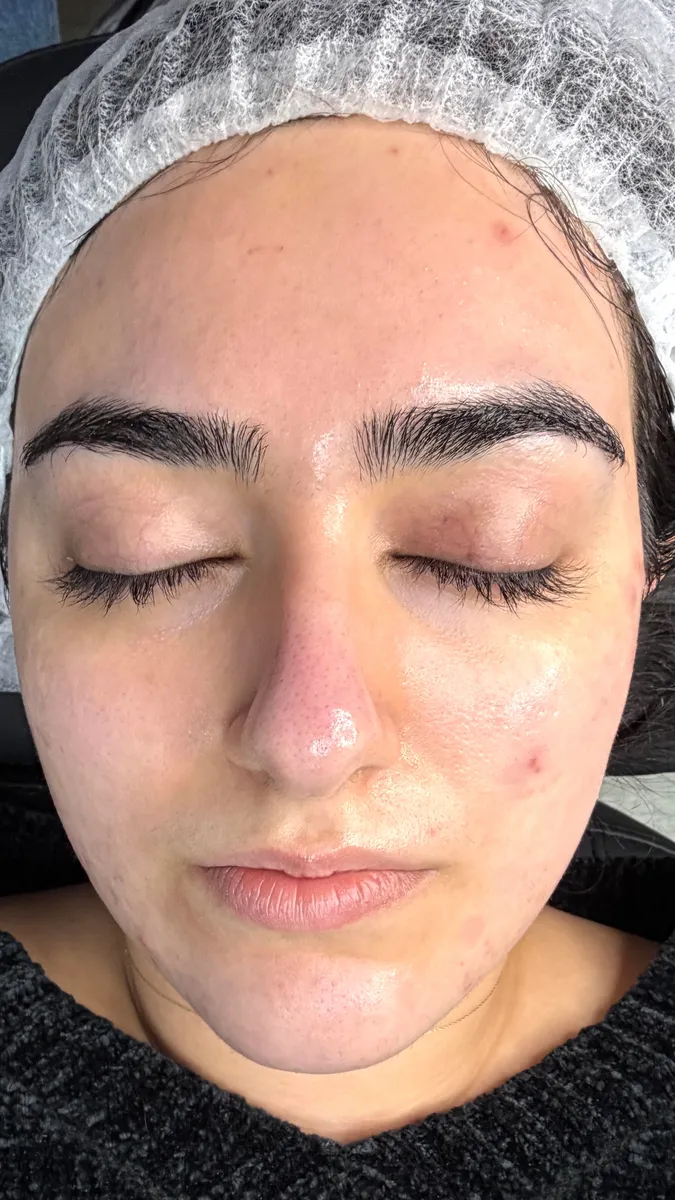 Before Phi-Hygienic Facial