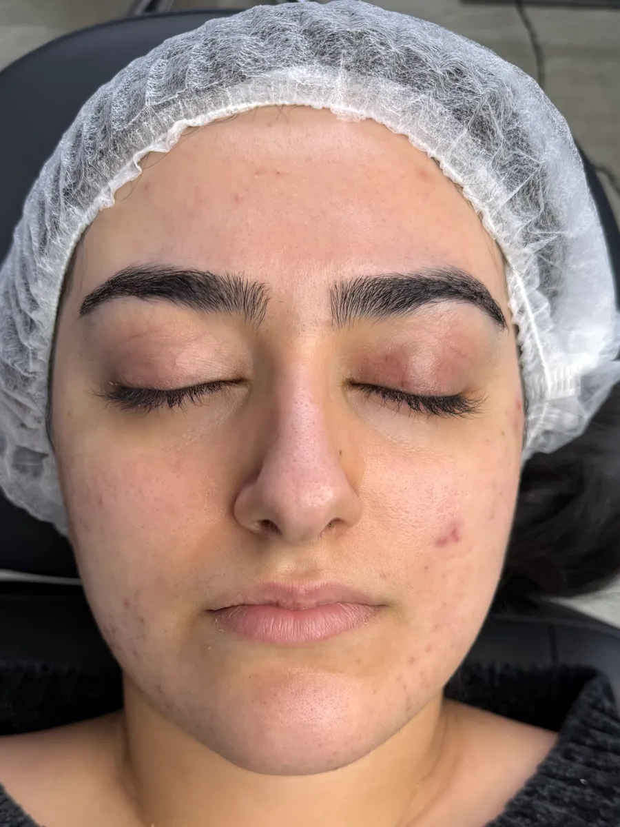 After Phi-Hygienic Facial